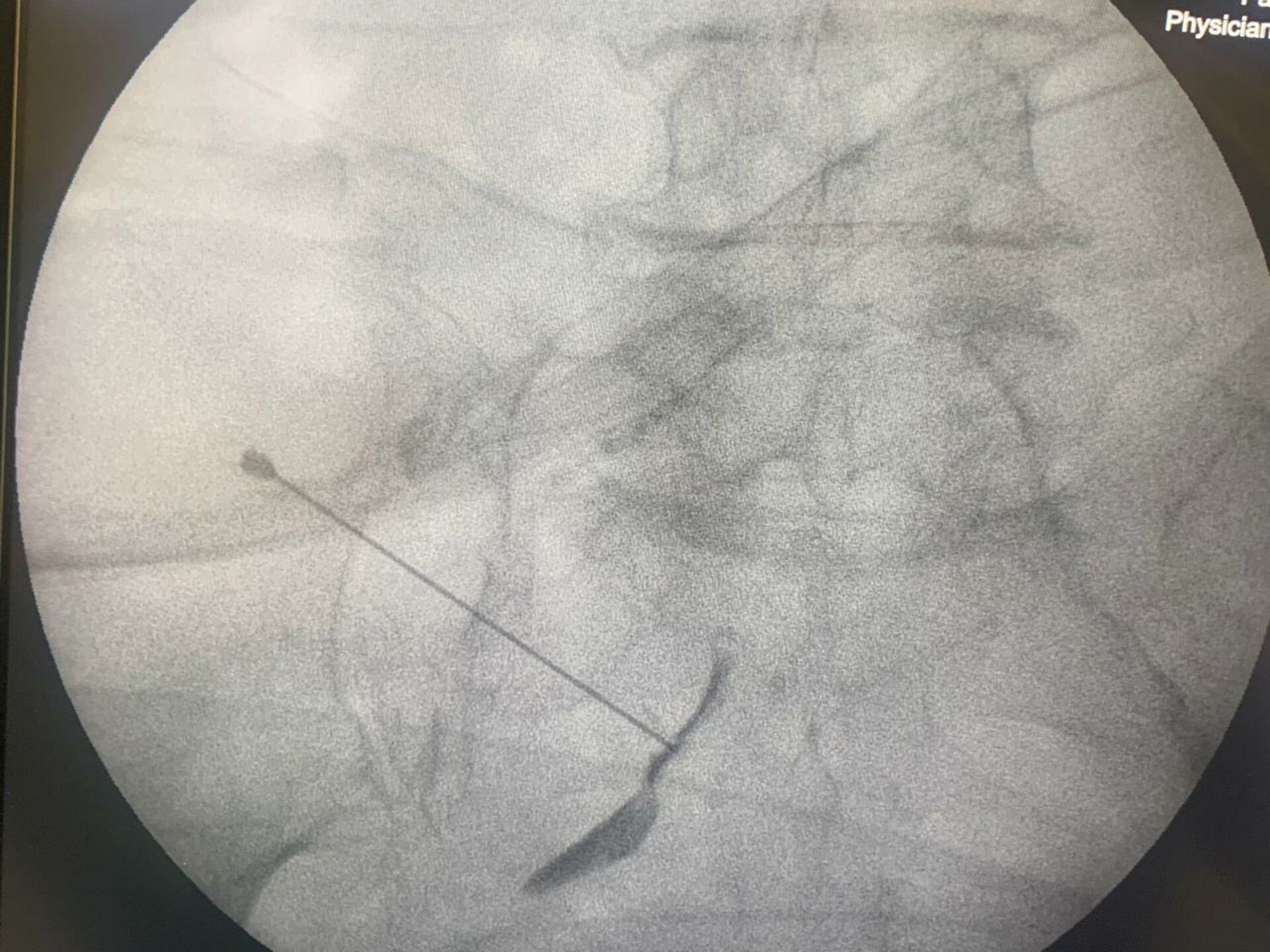 nerve root block